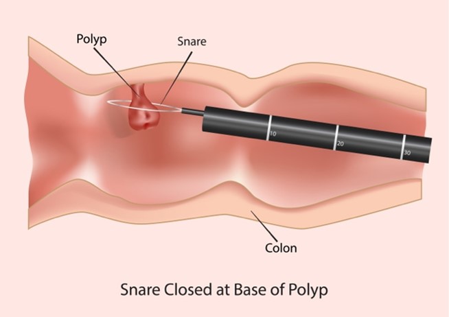 Illustration of a colonoscopy procedure removing polyp using a snare, preventing potential progression to colorectal cancer.