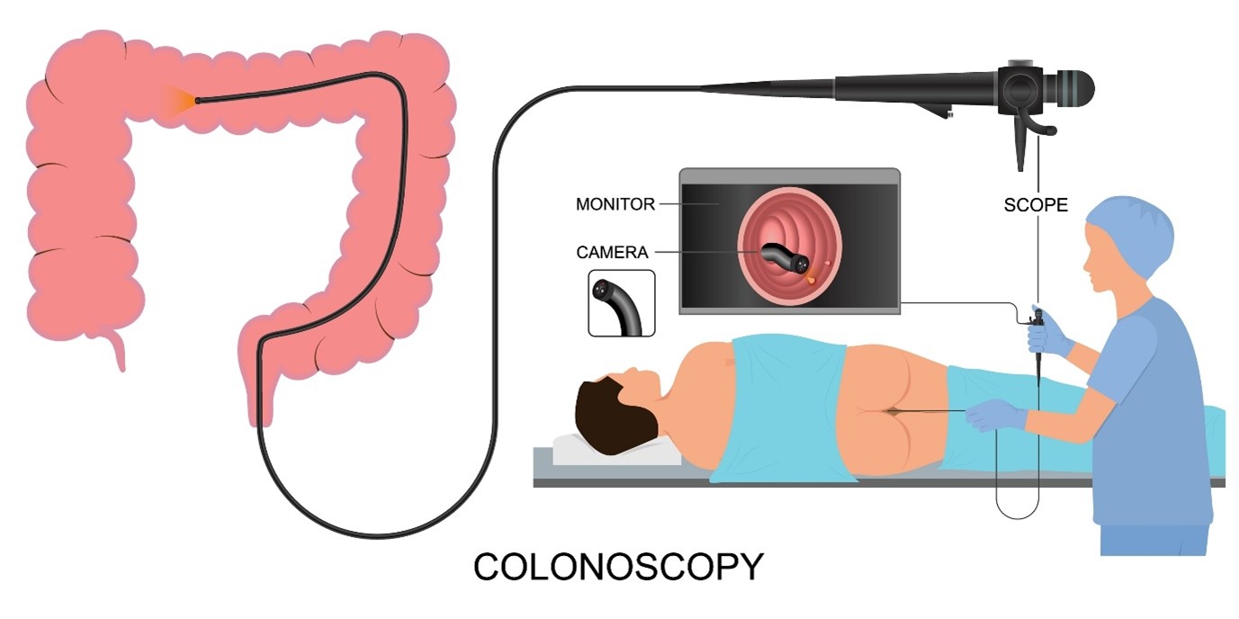 The Importance Of Colonoscopy For Colorectal Cancer Prevention The Importance Of Colonoscopy For Colorectal Cancer Prevention