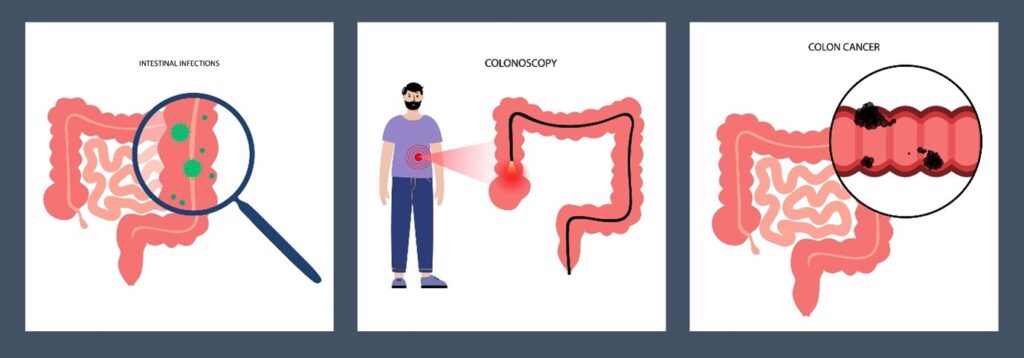 Three-step diagram showing intestinal infections, colonoscopy screening, and colorectal cancer detection for early prevention.