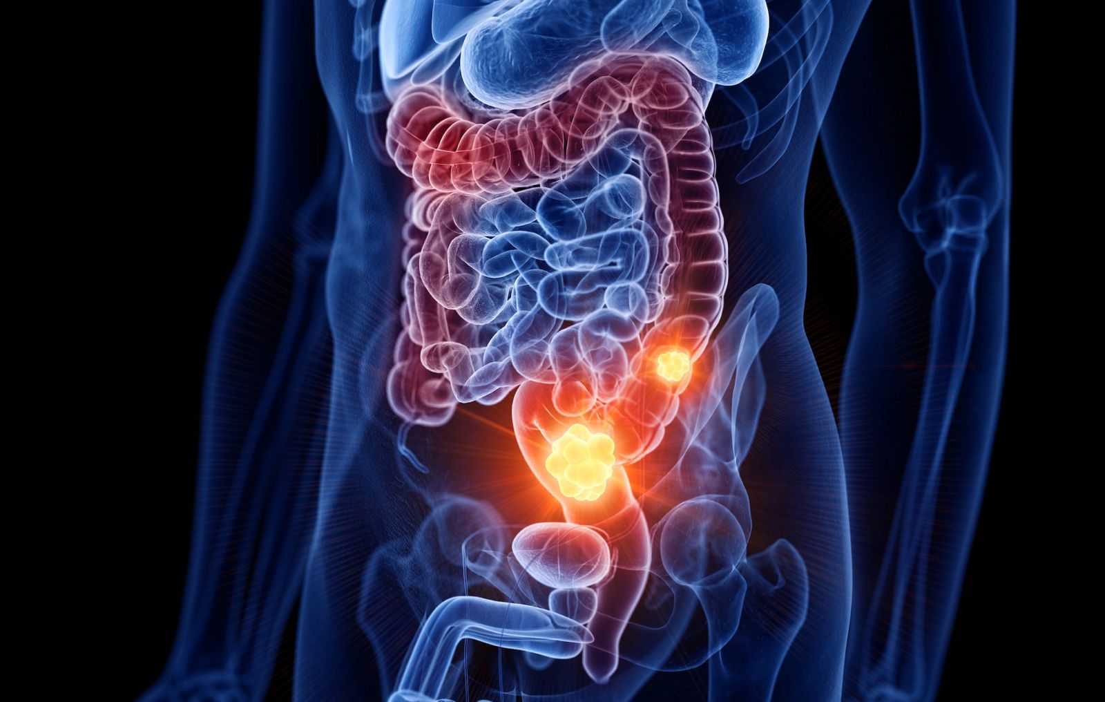 3D medical illustration highlighting colorectal cancer in the intestine, emphasizing the role of laparoscopic surgery in treatment.